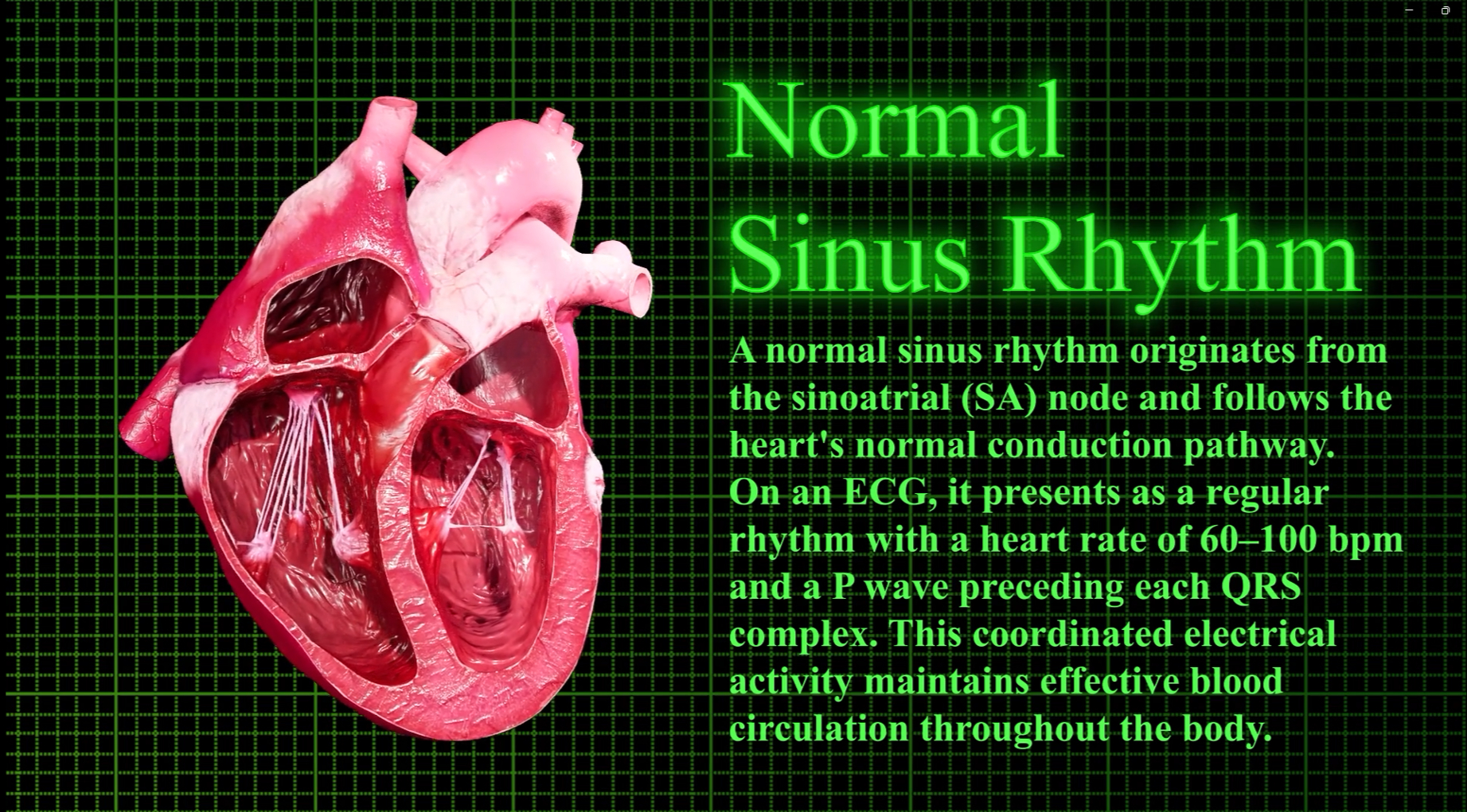 Normal Sinus Rhythm